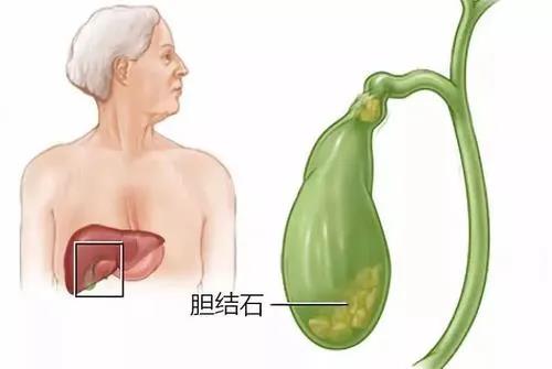 得了膽結石只能切膽囊嗎?顯微外科醫院“保膽取石”保留完整膽囊 11-23-1.jpg