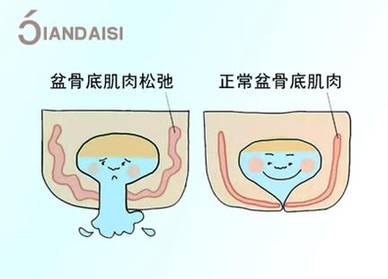 產(chǎn)后漏尿嚴重怎么治療?介紹2個經(jīng)驗