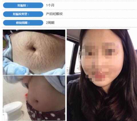 妊娠紋用什么產品好,權威祛妊娠紋產品排行榜