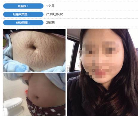 長了妊娠紋還能去掉嗎,祛妊娠紋方法大百科