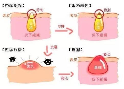 北京伊美爾幸福醫院:閉口粉刺會自己慢慢消失嗎?