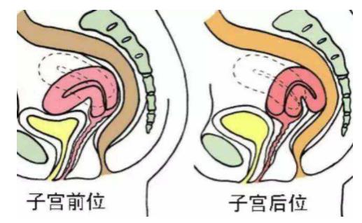 女性子宮后位影響受孕嗎 子宮后位懷孕的4個要點