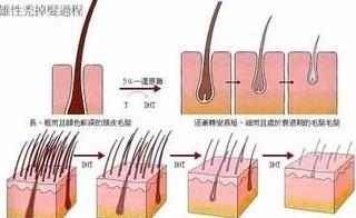 頭發越來越細,越稀怎么辦?脂溢性脫發,雄性脫發,護發仁