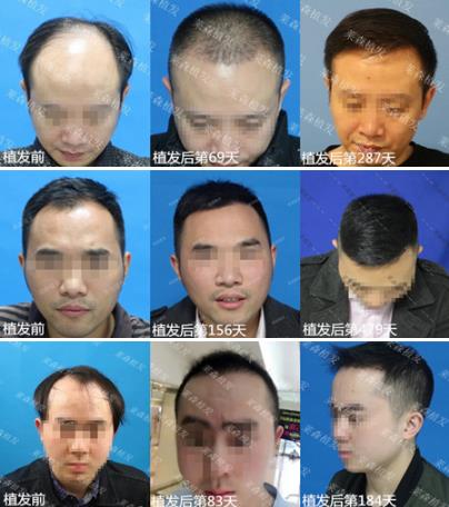 重慶萊森植發(fā)怎么樣 想要解決脫發(fā)禿頂