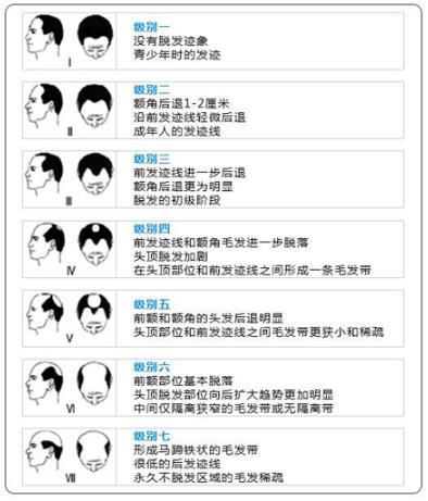重慶萊森植發(fā)怎么樣 想要解決脫發(fā)禿頂