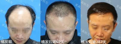 上海萊森植發(fā)醫(yī)院治脫方法 解決發(fā)友“頭等大事”