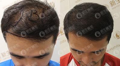 合肥新生植發(fā)科普,植發(fā)受季節(jié)的影響嗎?哪個季節(jié)植發(fā)最好?