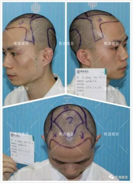 在深圳青逸植發醫院舉辦的實力青逸,技術“植”播圓滿成功