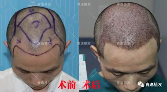 在深圳青逸植發醫院舉辦的實力青逸,技術“植”播圓滿成功