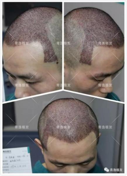 在深圳青逸植發醫院舉辦的實力青逸,技術“植”播圓滿成功