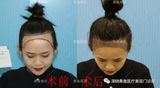 青逸植發(fā)醫(yī)院眾多醫(yī)生跟專家一同見證青逸咨詢助理唯唯的完美蛻變