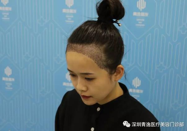 青逸植發(fā)醫(yī)院眾多醫(yī)生跟專家一同見證青逸咨詢助理唯唯的完美蛻變