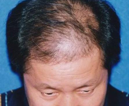 男性脫發(fā)嚴重煩惱多多 推薦男人防脫發(fā)的6個小妙招