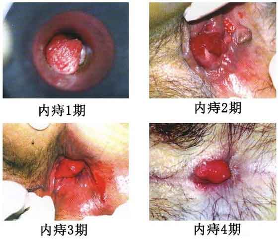 女性痔瘡真人實拍圖片 網上曝光的7個小偏方有效治痔瘡 女性痔瘡真人實拍圖片:網上曝光的7個小偏方有效治痔瘡