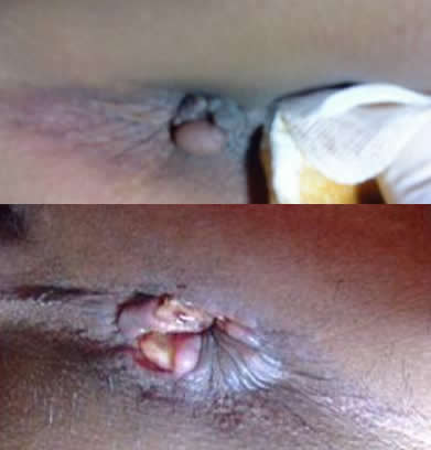 女性痔瘡真人實拍圖片 網上曝光的7個小偏方有效治痔瘡 女性痔瘡真人實拍圖片:網上曝光的7個小偏方有效治痔瘡