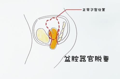 得了盆腔臟器脫垂怎么辦?盆腔臟器脫垂患者如何護理