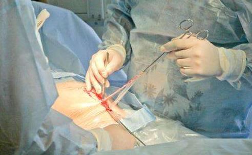 你想做剖腹產嗎 剖腹產的好處與弊端