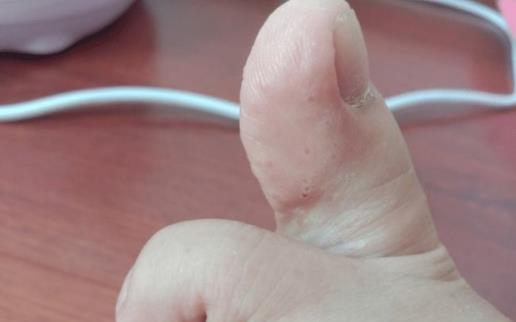 腳氣是身體在排毒嗎 腳氣會通過鞋子傳染嗎