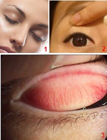 眼睛里進東西怎么辦？眼睛進異物怎么辦