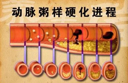 動脈粥樣硬化