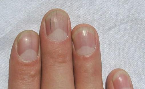 如何從指甲形狀看個(gè)性和疾病