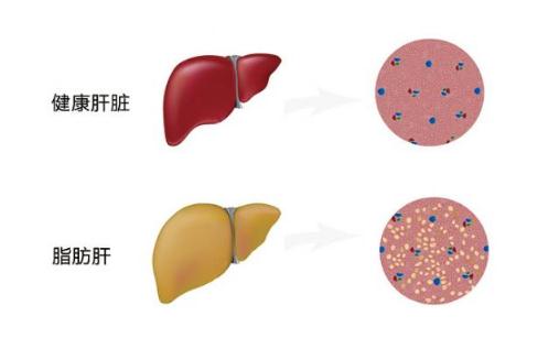 脂肪肝的治療方法 應酬男應該看看