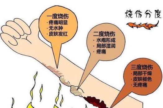 阻止繼續燒傷只要18秒