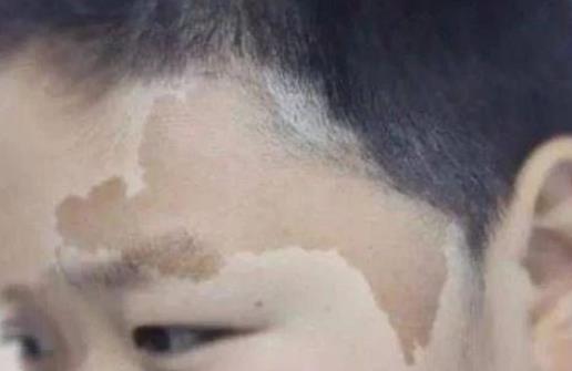 身上長這種顏色胎記竟暗藏殺機 小心胎記可能是疾病信號