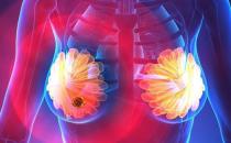乳腺結節對女性危害大 乳腺結節形成的原因及預防
