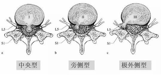 患上腰椎病，一定不能拖！內(nèi)鏡微創(chuàng)手術(shù)，一步治好它！