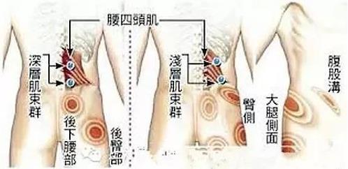 湛江崇愛康復醫院科普如何防治肌筋膜炎 以真誠來服務患者
