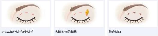 北京彤美整形醫院劉風卓：雙眼皮手術恢復需要多久