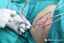 廣州復大腫瘤醫院牛立志：晚期肺癌引起失眠如何治療