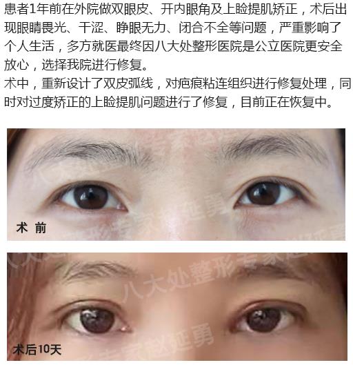 八大處整形趙延勇眼修復怎么樣 用實力鑄就業內口碑