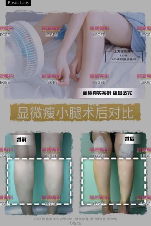 上海麗質美學整形門診部做瘦小腿價格貴嗎？肌肉小腿太難減怎么辦