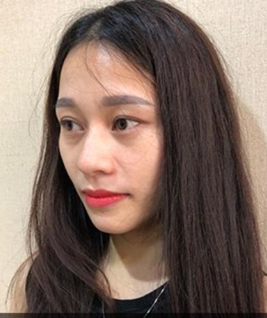 幻柔筆記：眼袋修復(fù)后氣質(zhì)立現(xiàn)，怎么看都是青春靚麗！