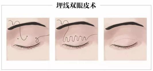 上海玫瑰整形醫(yī)院雙眼皮手術(shù)怎么樣？輕松擁有靚麗雙眼