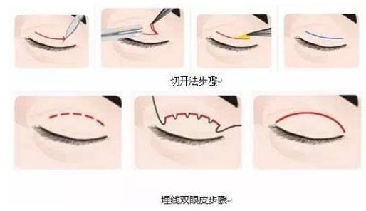 上海玫瑰整形醫(yī)院雙眼皮手術(shù)怎么樣？輕松擁有靚麗雙眼
