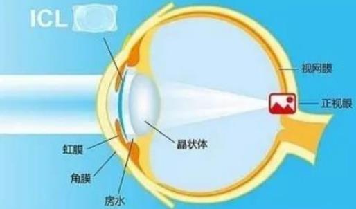 西安普瑞眼科醫(yī)院好嗎？戴眼鏡VS近視手術，四個對比讓你不糾結