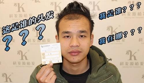 青島大麥微針植發2500毛囊單位，術后8個月恢復頭發濃密